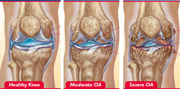 tai chi for knee osteoarthritis